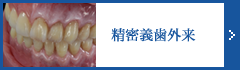 精密義歯外来