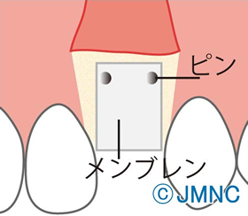 2.自家骨や人工骨などの骨補填剤を入れ、メンブレンで覆う